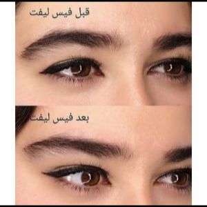 کش لیفت شقیقه