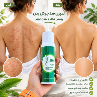 اسپری ضد جوش بدن سایازو (SIAYZU)