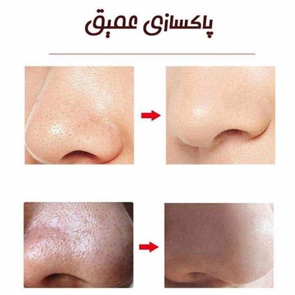 میکرودرم خانگی