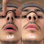 گیره رفع خروپف