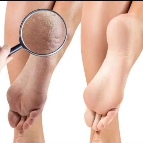 جوراب سیلیکونی رفع ترک پا