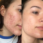 سرم پیلینگ اوردینری  The Ordinary AHA 30% + BHA 2% Peeling Solution