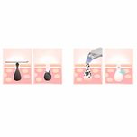 میکرودرم شارژی پوست