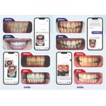 کیت بلیچینگ سفید کننده دندان خانگی دنتیلایت مدل Smile مجموعه 5 عددی