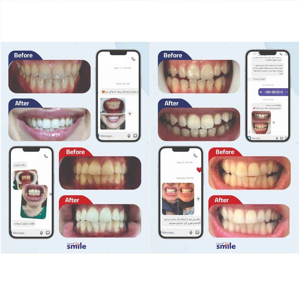 کیت بلیچینگ سفید کننده دندان خانگی دنتیلایت مدل Smile مجموعه 5 عددی