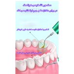 دستگاه جرمگیر دهان و دندان و مدل JYQOO2