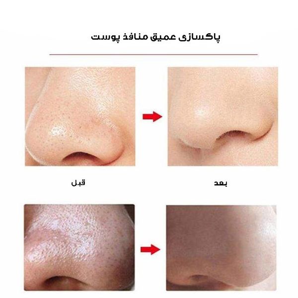 میکرودرم شارژی پوست