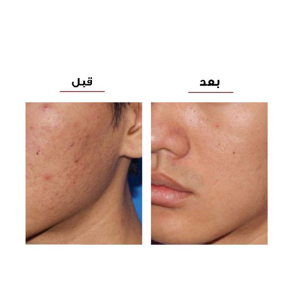 میکرودرم شارژی پوست