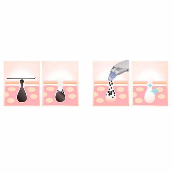 میکرودرم خانگی