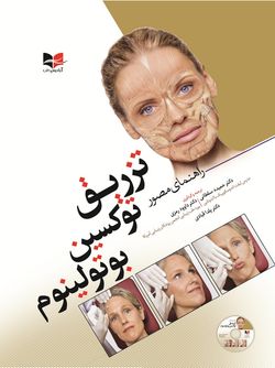 راهنمای مصور تزریق توکسین بوتولینوم